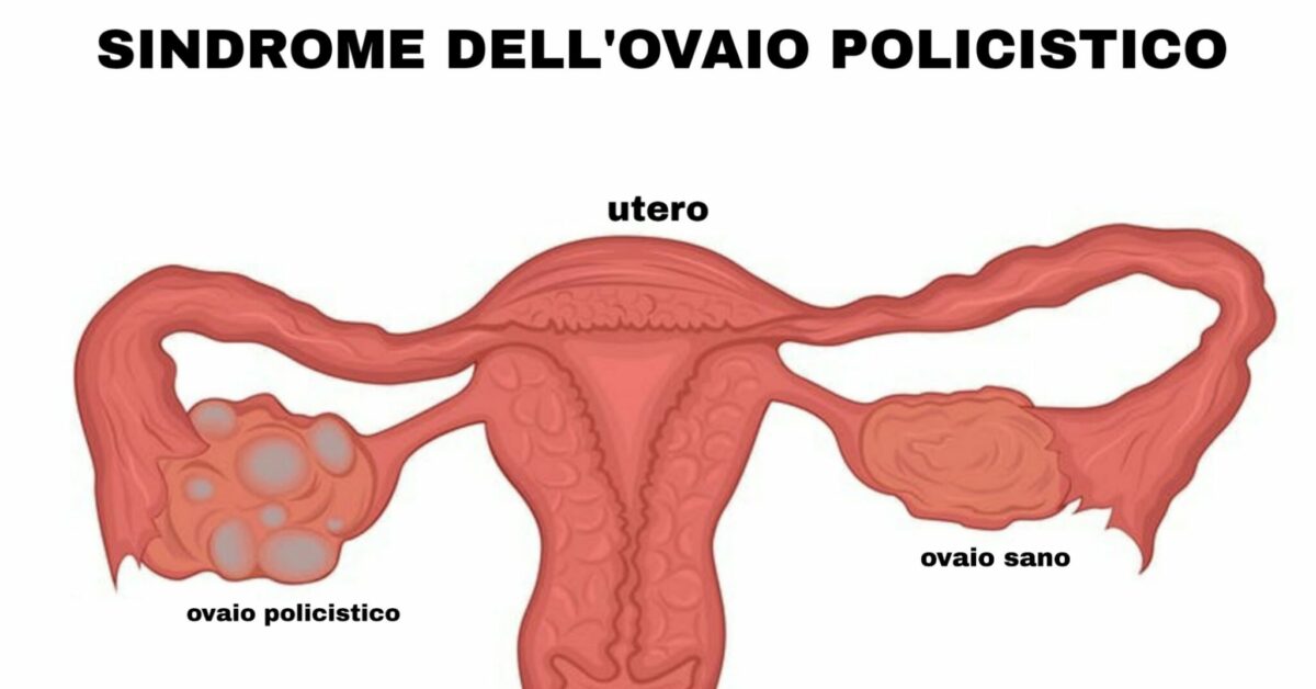 Sindrome Dell Ovaio Policistico