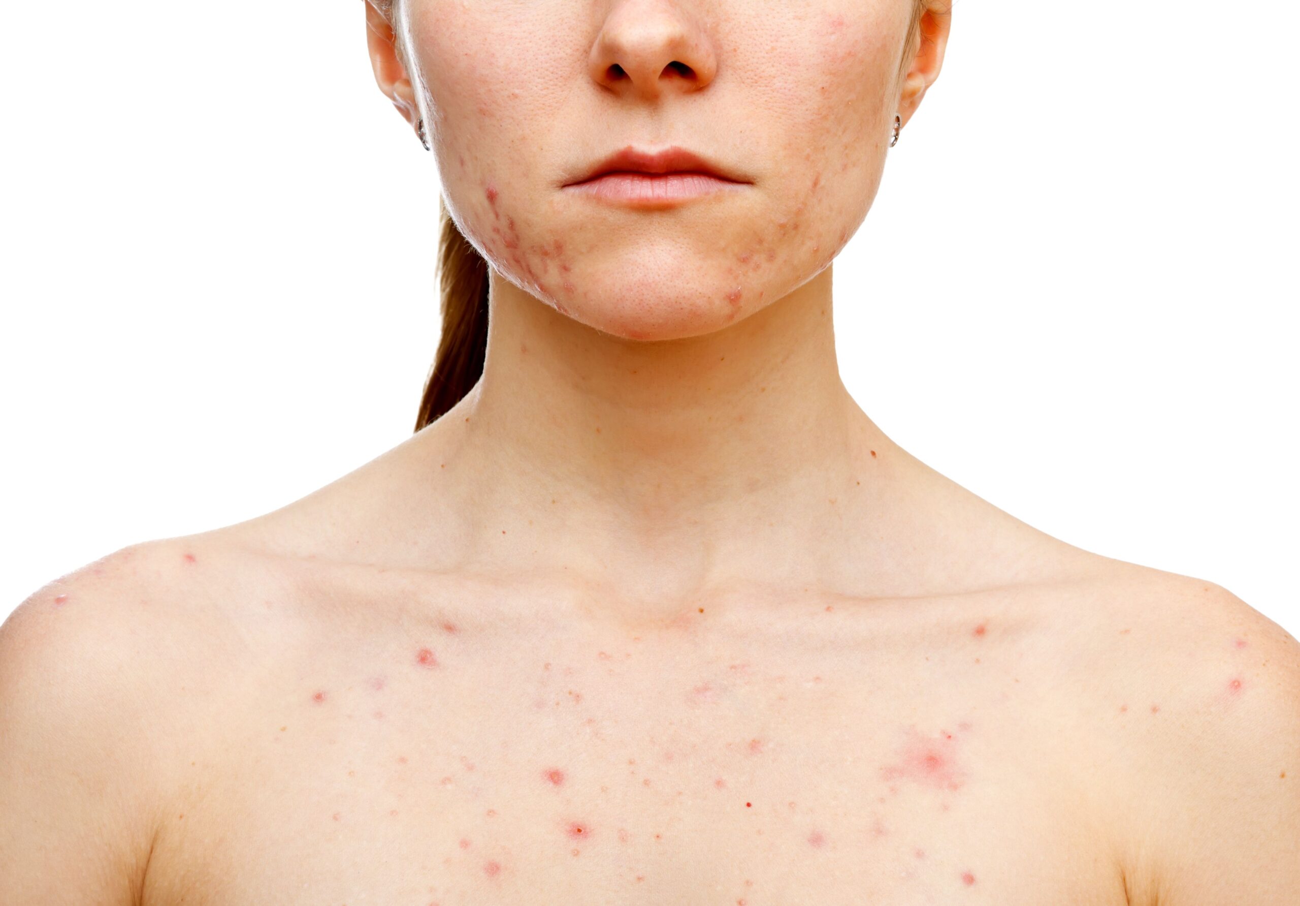 Rimedi per curare l’acne sulla schiena, spalle e décolleté