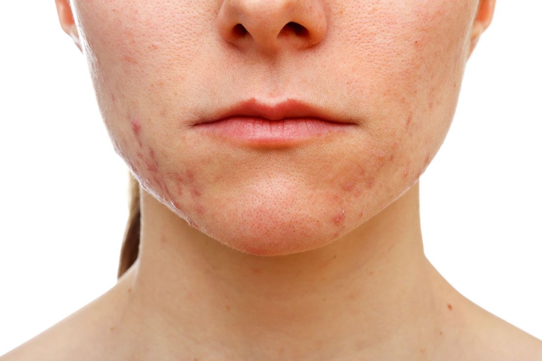 Acne Adulta Rimedi Naturali Per Migliorare