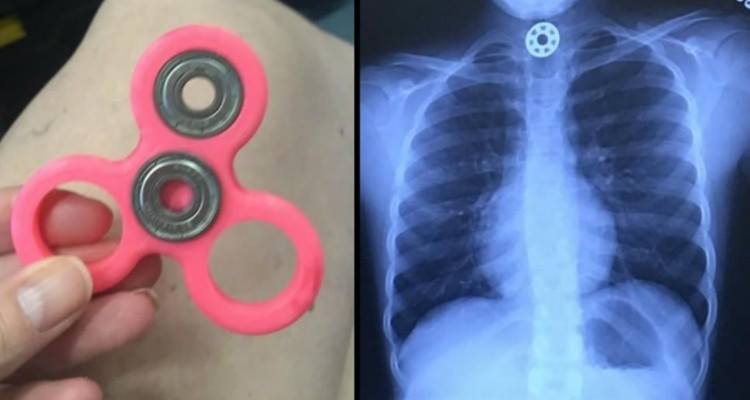 Altro che antistress, bambina rischia di soffocare con lo Spinner!