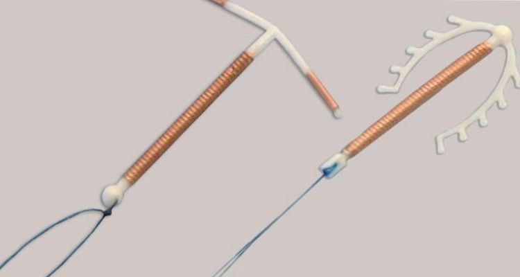 6 cose che nessuno ti dice sulla spirale intrauterina (IUD)