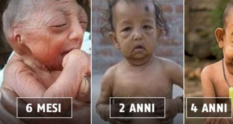 Il Benjamin Button del Bangladesh oggi ha 4 anni