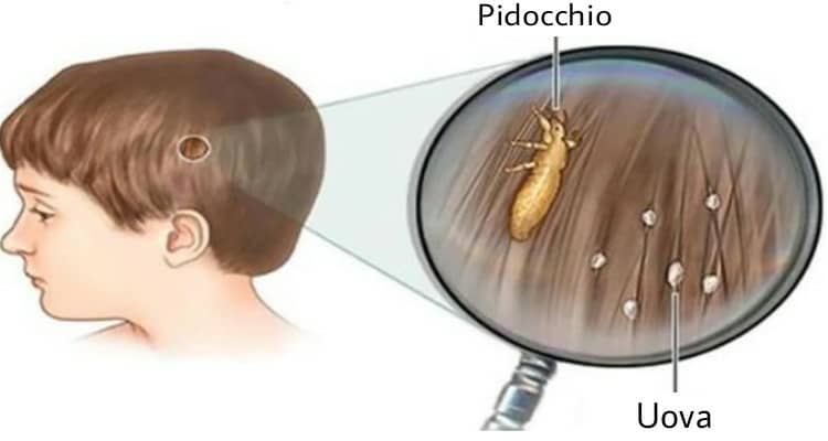 Un rimedio naturale per liberarvi dai pidocchi