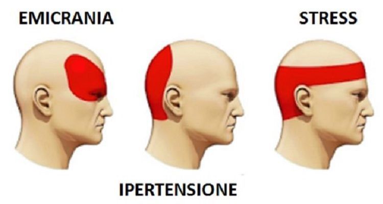 Eliminare il mal di testa in 5 minuti senza ricorrere ai farmaci