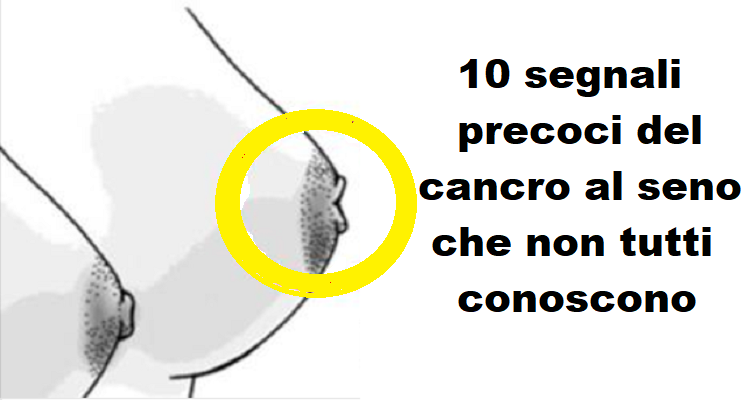 I segnali precoci del cancro al seno che non tutti conoscono