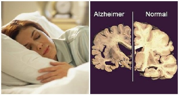 La mancanza di sonno può essere legata alla comparsa dell’Alzheimer