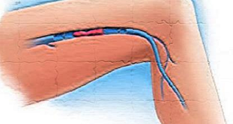 Trombosi venosa nelle gambe, i sintomi da conoscere