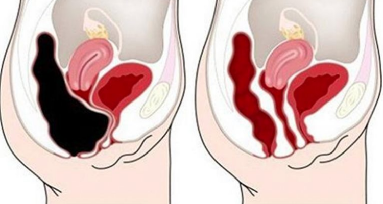 Come rimuovere i rifiuti dal colon in modo rapido e sicuro