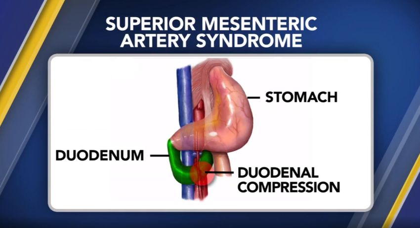 sindrome dell'arteria mesenterica superiore