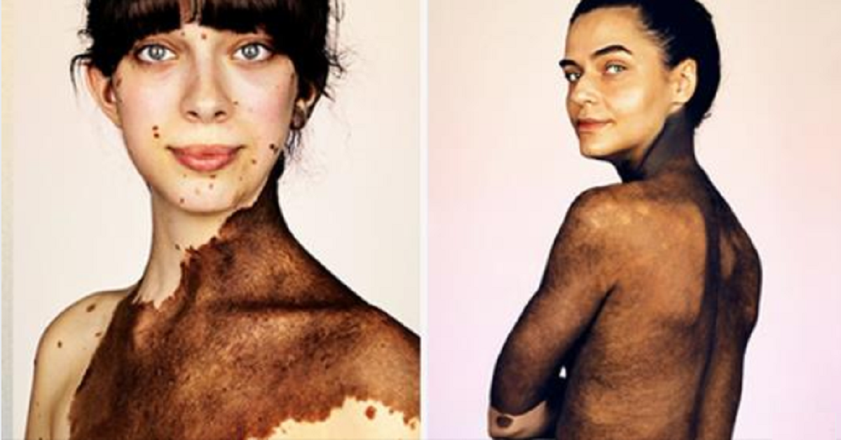 “Love the skin you are in”, in mostra le persone con pelli rare