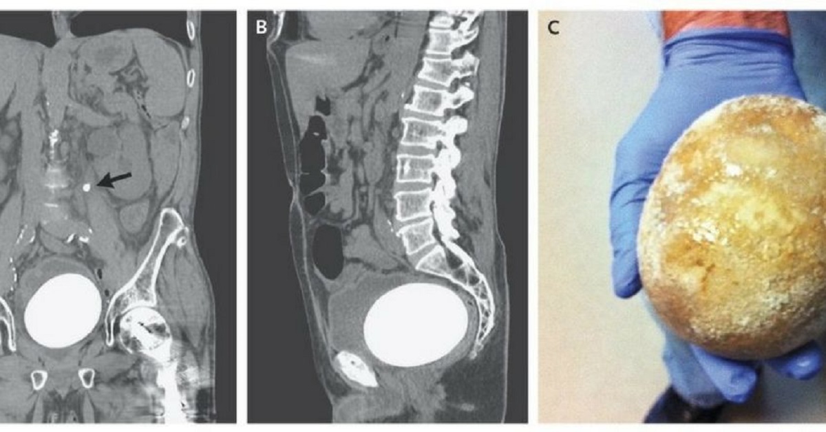 Calcolo grosso come un uovo di struzzo rimosso dalla vescica dell’uomo