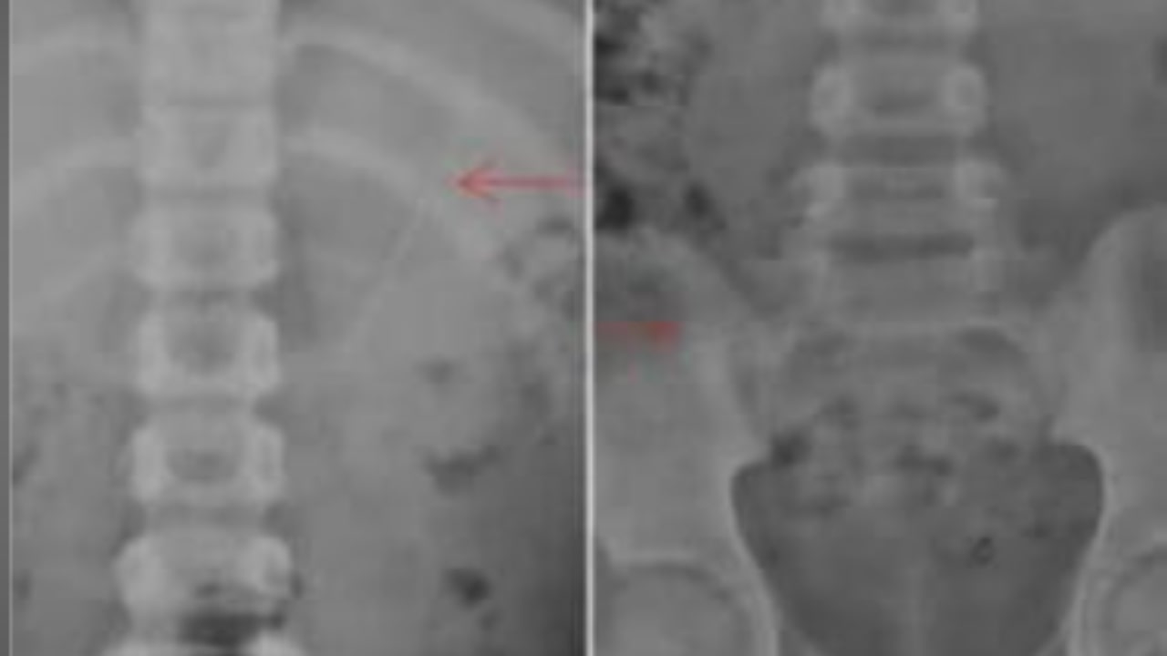 Radiografie mostrano la posizione della matita nel corpo del bambino
