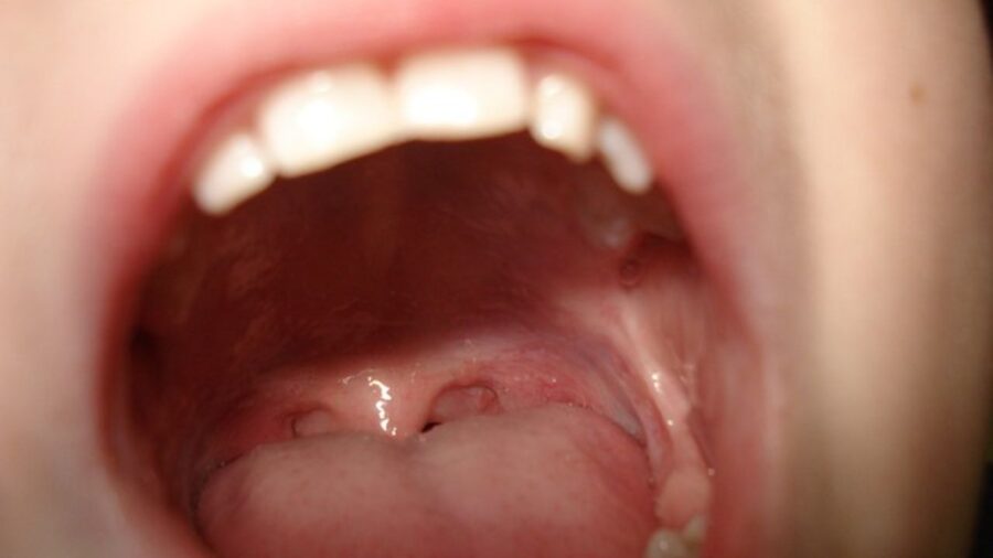 Saliva and bacteria as the first sign of gastric cancer;  photo from the archive