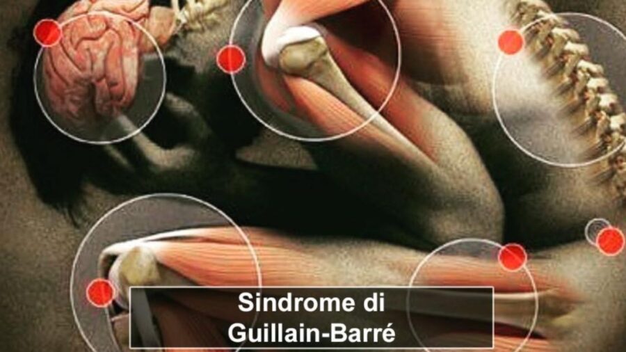 Giullain-Barré syndrome