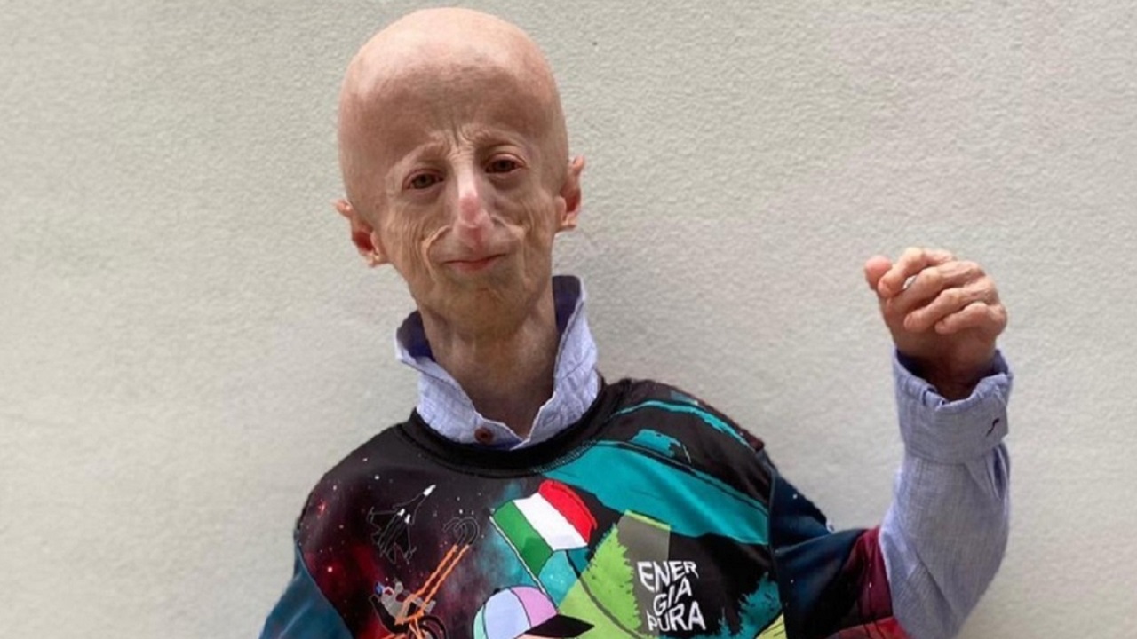 sammy basso morto: era affetto da progeria