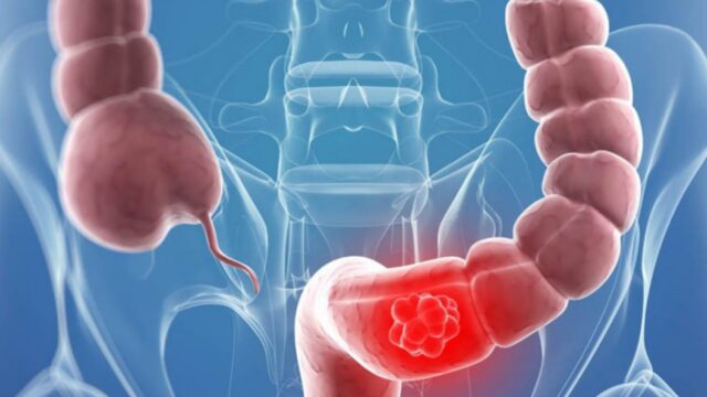 Tumore al colon, è allarme per l’aumento dei casi: ecco i 10 alimenti da mangiare quotidianamente per prevenirlo